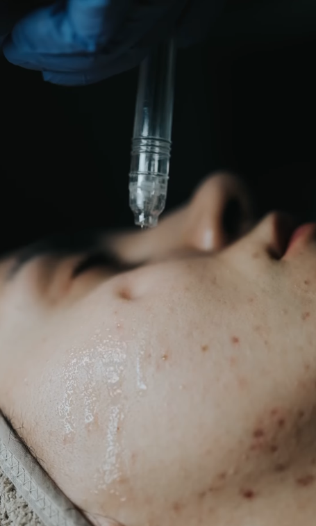 Hydrafacial bakım görseli