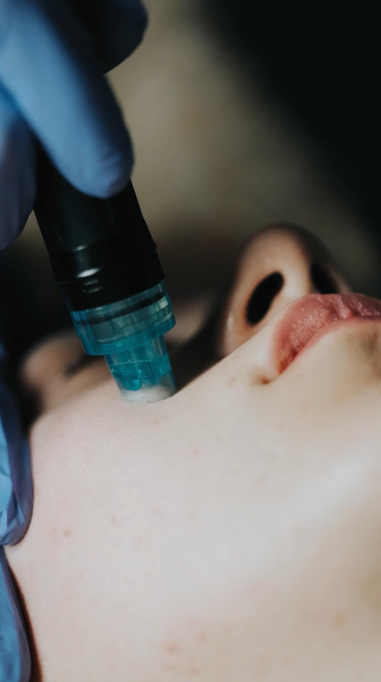 Yanak bölgesi için hydrafacial görseli