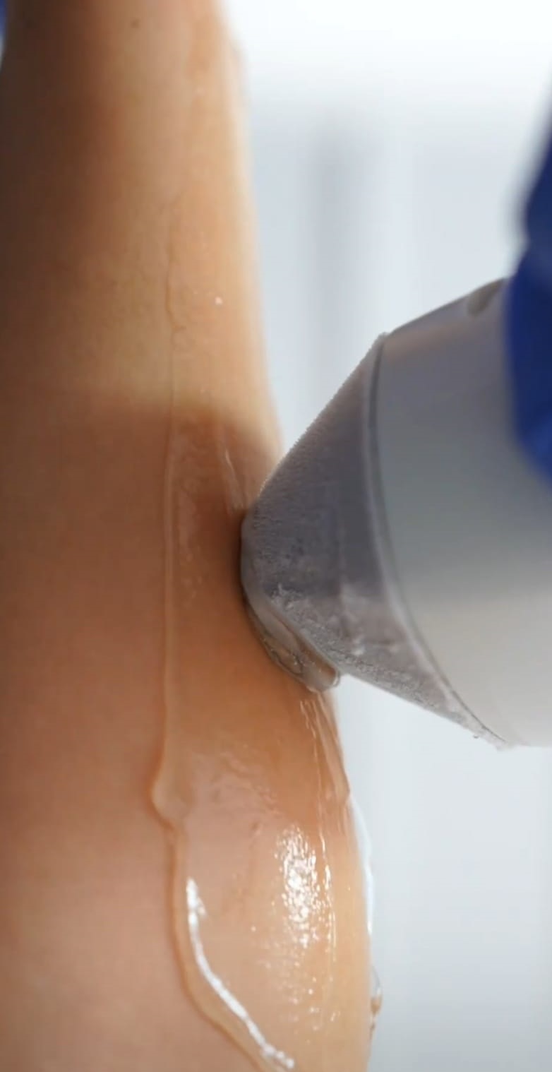 Buz başlıklı lazer epilasyonun görseli